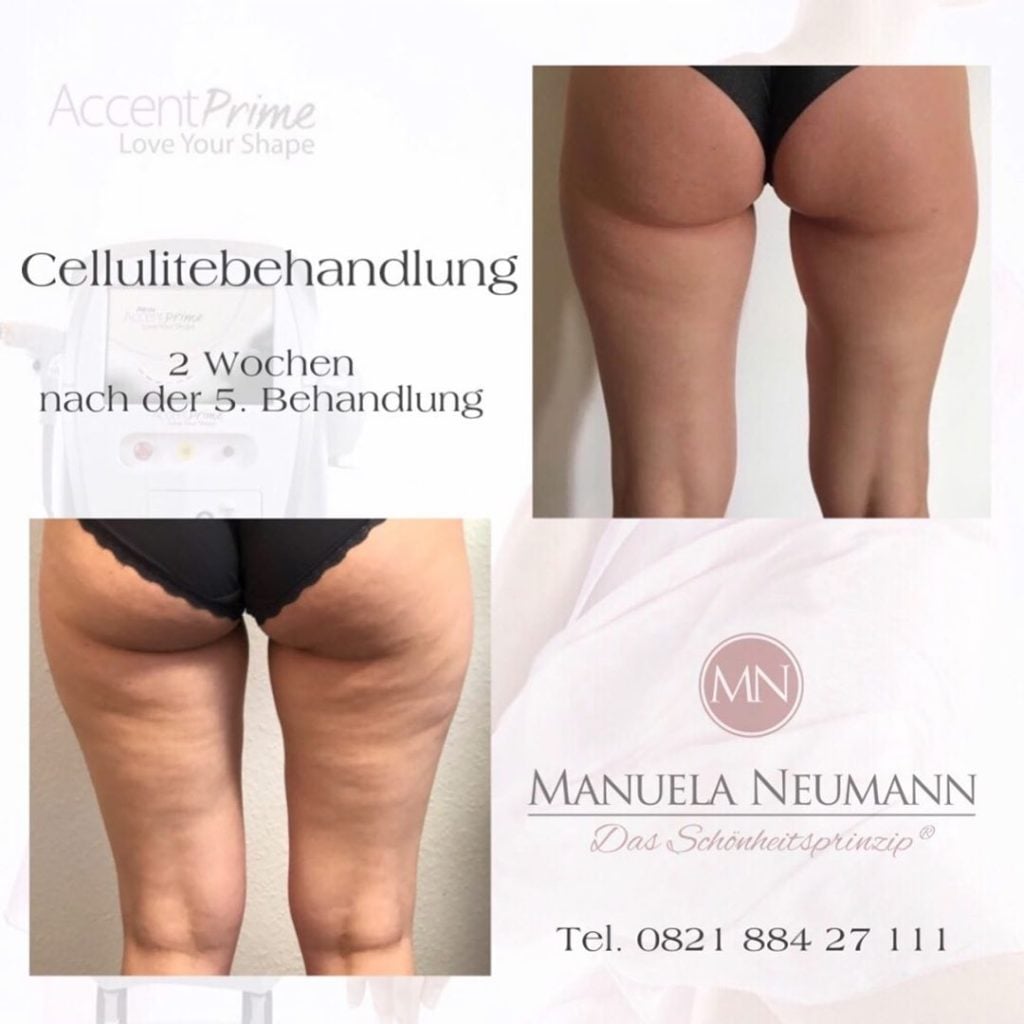 radiofrequency treatment before and after photos